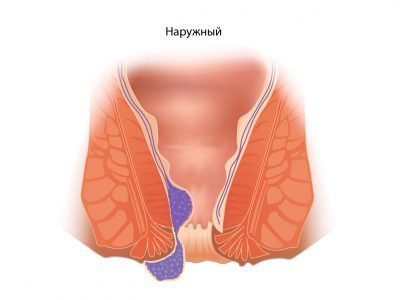 Внутренний и наружный геморрой: чем отличается лечение