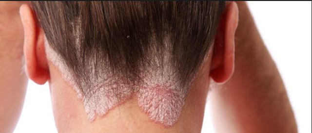 Почему чешется голова - причины, лечение зуда кожи головы