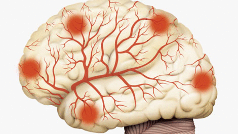 Как проверить сосуды головного мозга: диагностика, методы