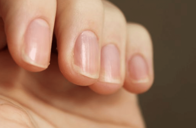 Продольные полосы на ногтях: причины и методы лечения
