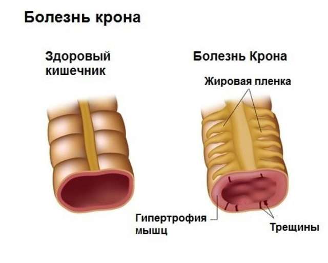 Заболевание кишечника: признаки, диета, и диагностика болезни