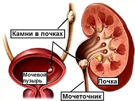 Затрудненное мочеиспускание у мужчин - причины и лечение