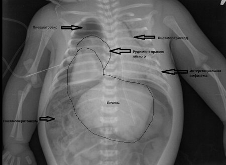 Диафрагмальная грыжа у детей: причины, симптомы, диагностика, лечение