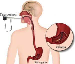 Показания и противопоказания к проведению процедуры ФГДС