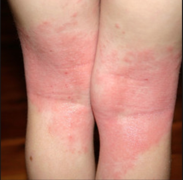 Инфекционный дерматит на ногах – лечение мазью