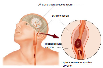 Инсульт - причины, симптомы, диагностика и лечение