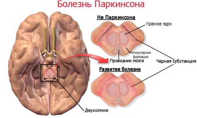 Общее и отличия Паркинсонизма и болезни Паркинсона
