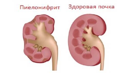 Синдромы и симптомы при остром пиелонефрите