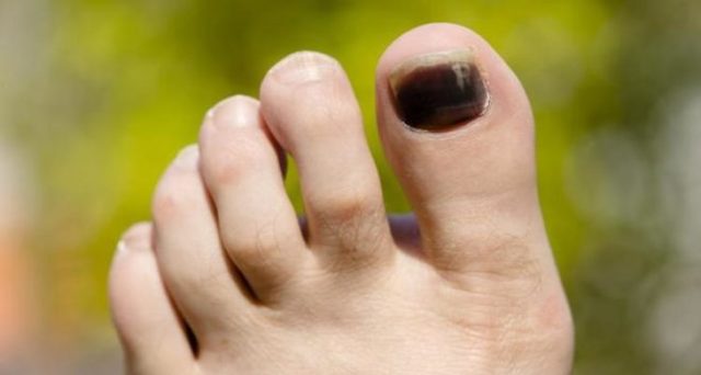 Почему чернеют ногти на ногах у женщин и как лечить