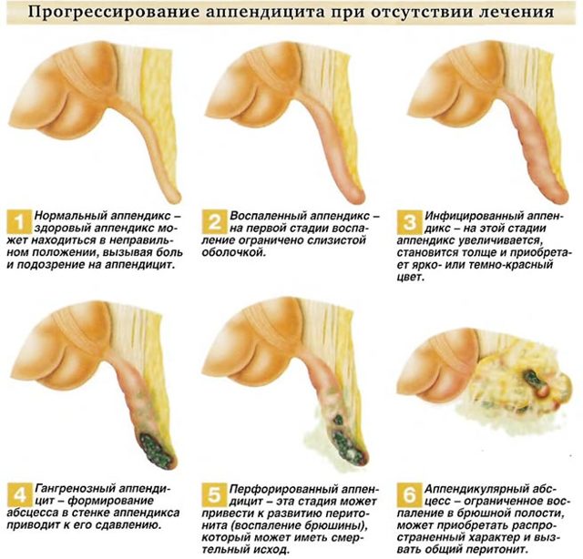 Может ли быть понос при аппендиците и как его лечить