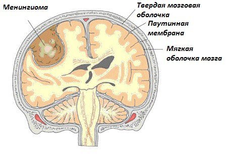 Чем вызвана менингиома головного мозга - причины, симптомы, лечение