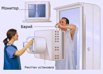 Рентгеноскопия желудка с барием: подготовка, методика проведения, результаты