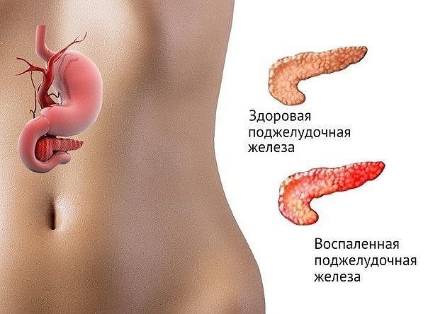 После алкоголя болит поджелудочная