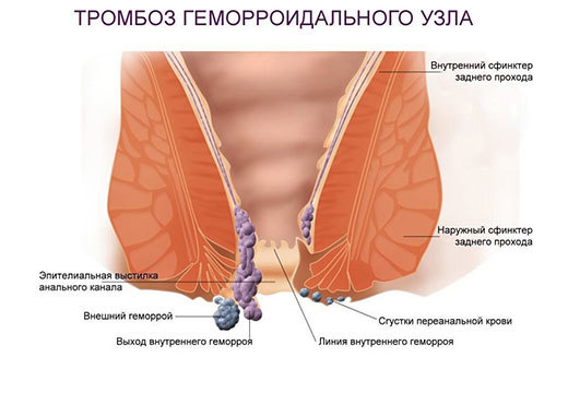 Понос с кровью у взрослого: причины, симптомы и лечение