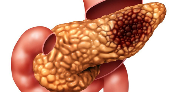 Рак поджелудочной железы - причины, симптомы, диагностика и лечение, прогноз