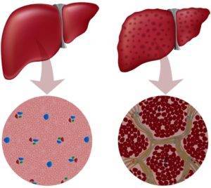 Симптомы цирроза печени у мужчин алкоголиков и лечение болезни