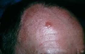 Базалиома кожи - симптомы, лечение, удаление