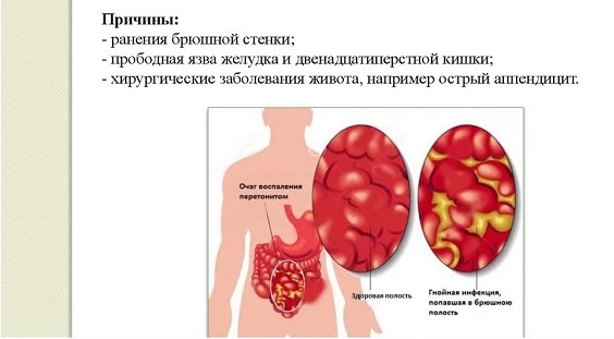 Гнойный перитонит – виды, причины, симптомы и лечение