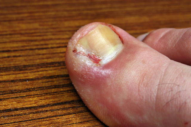 Болит и гноится большой палец на ноге у ногтя: что делать и как лечить