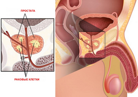 Дикловит свечи при простатите