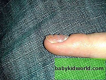 Ребристые ногти на руках: причины у женщин, почему ногтевая пластина стала вертикально и вдоль с полосками, бугристые неровности, лечение