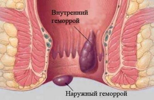 Внутренний и наружный геморрой: чем отличается лечение