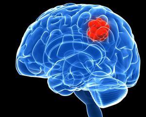 Первые признаки рака головного мозга: как определить патологию
