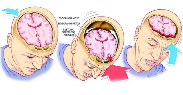 После сотрясения мозга болит голова - что делать, сколько дней, лечение