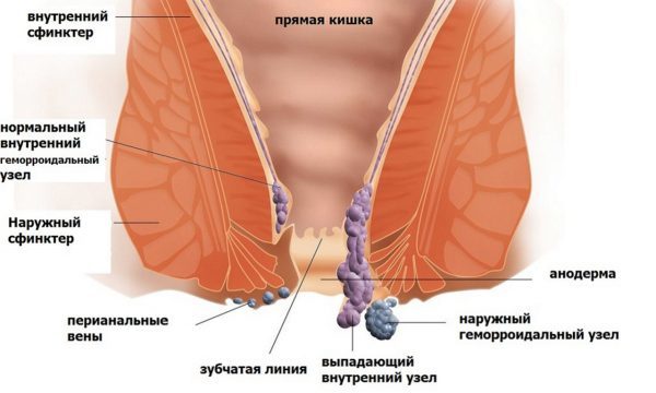 Внутренний и наружный геморрой: чем отличается лечение