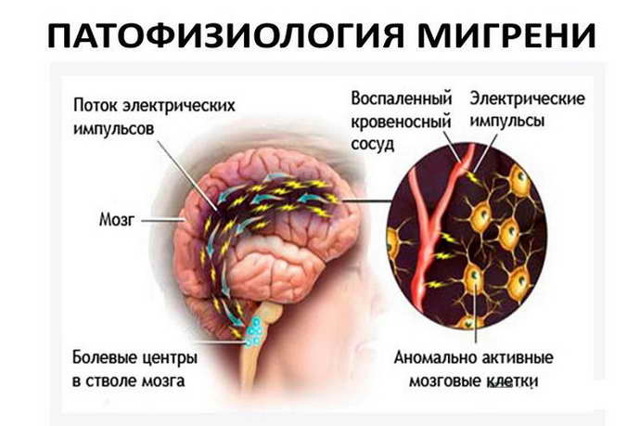 Почему рвота при мигрени - Симптомы и лечение болезней