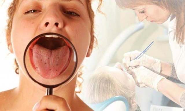 Грибок во рту у взрослого и ребенка: причины, симптомы (ФОТО) и методы лечения