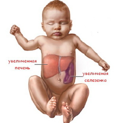 Гепатомегалия печени: что это такое, признаки, лечение препаратами