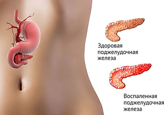 Хронический панкреатит: симптомы и лечение у взрослых