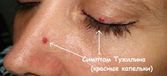 Пятна на коже при заболеваниях поджелудочной железы: кожные проявления, красные точки, сыпь, высыпания