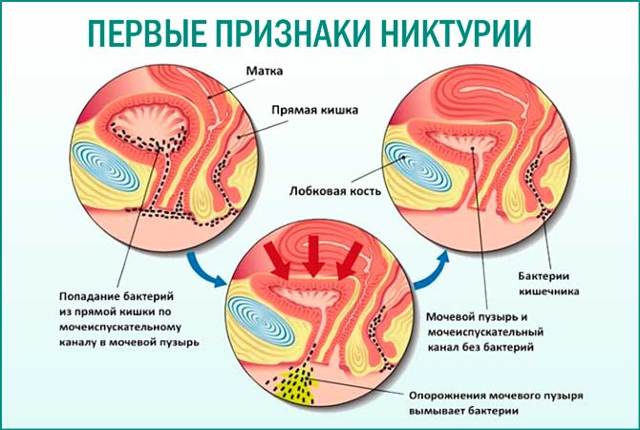 Частое ночное мочеиспускание у мужчин, никтурия - частые позывы к мочеиспусканию ночью