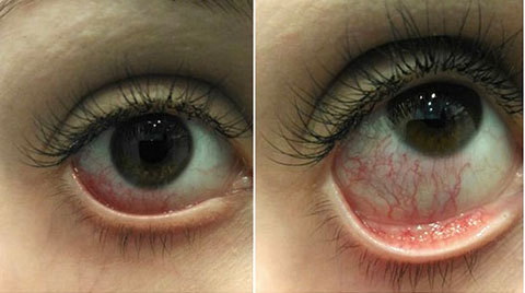 Красные глаза после наращивания ресниц: почему они такие и болит внизу один или оба, нормально ли это, что делать, как убрать, через сколько пройдет, каково лечение?