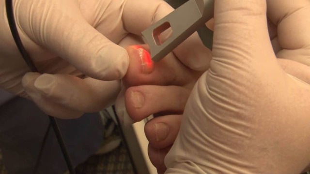 Патогенные грибы на коже, ногтях: лечение, исследование