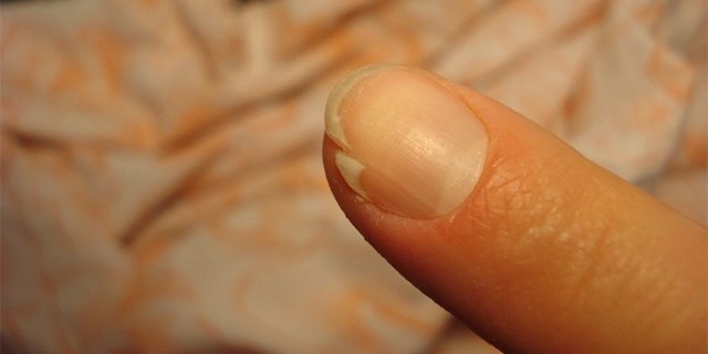 Трещина на ногте — причины и что делать?