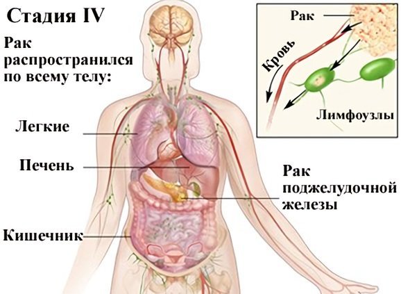 Рак поджелудочной железы: первые симптомы (проявления), фото