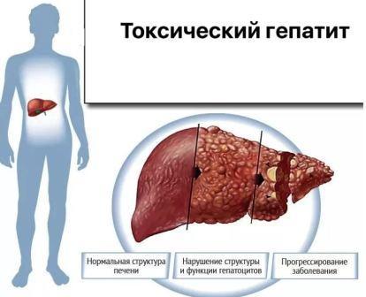 Умеренные диффузные изменения паренхимы печени