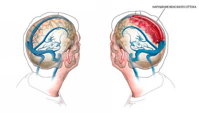 Венозная дисциркуляция головного мозга в ВББ: что это такое, признаки