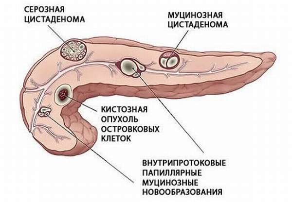 Полипы в поджелудочной железе: причины и лечение