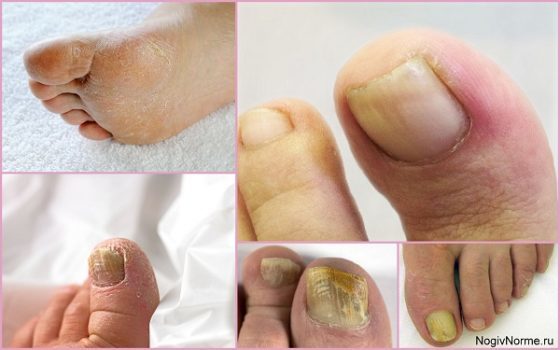 Эфирные масла от грибка ногтей на ногах: лучшие рецепты для лечения онихомикоза