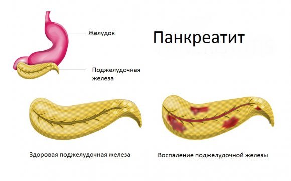 Болезни печени и поджелудочной железы: симптомы и лечение