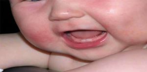 У ребенка аллергия во рту и вокруг него