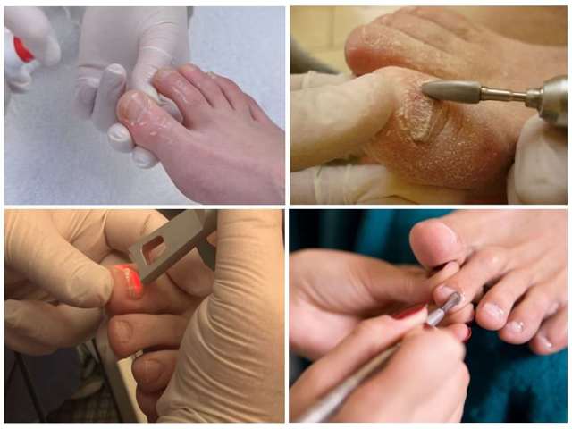 Онихомикоз ногтей: лечение препаратами, лазером и народными средствами