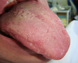 У ребенка аллергия во рту и вокруг него
