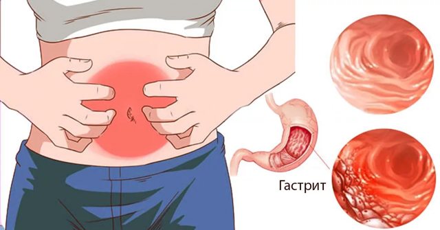 Народные средства лечения гастрита с повышенной кислотностью