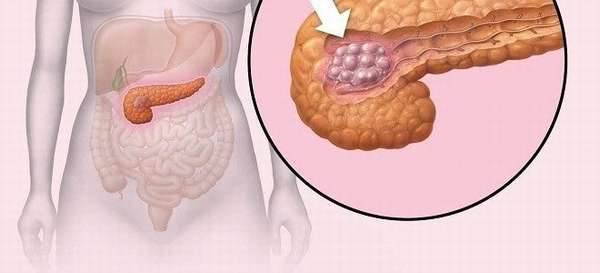 Полипы в поджелудочной железе: причины и лечение