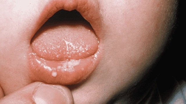 Признаки и фото стоматита у детей во рту
